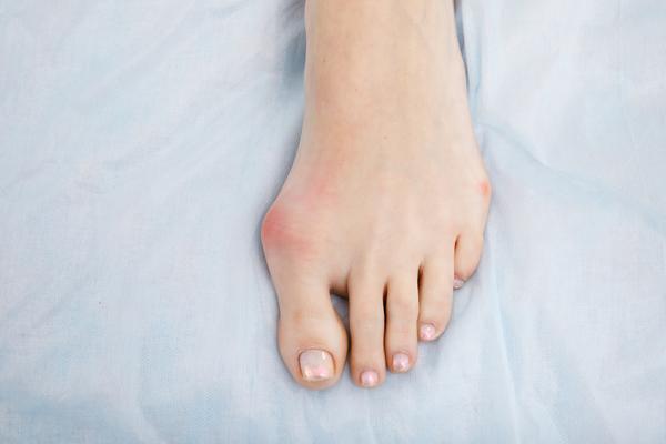 外反母趾が痛い時どうする？原因と予防方法、治し方を解説