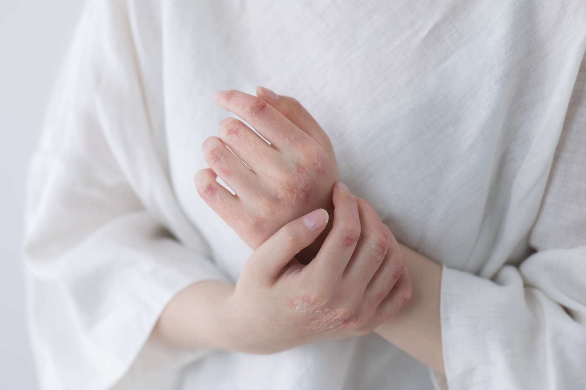 アトピー性皮膚炎を引き起こす要因