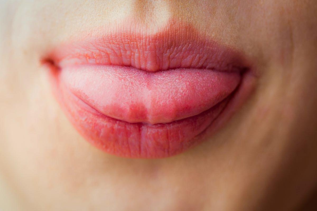 舌のぶつぶつのその他の原因…舌扁桃や舌ガンなどの病気の可能性も